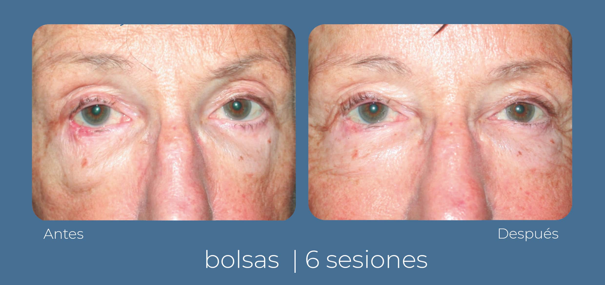 Vista frontal del antes y después que obtuvo una paciente luego de aplicarse el tratamiento INDIBA facial