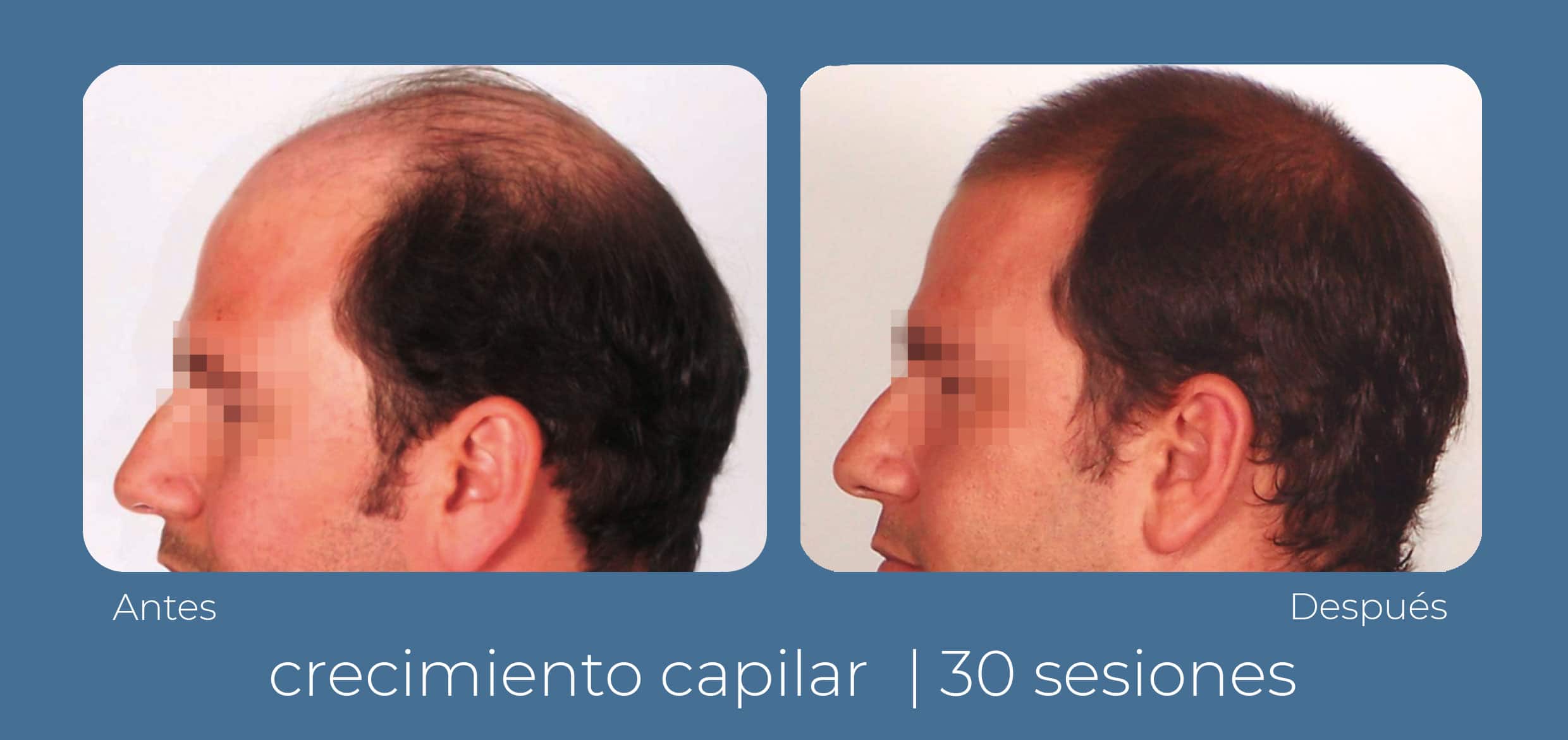 Vista lateral del antes y después de un tratamiento INDIBA capilar