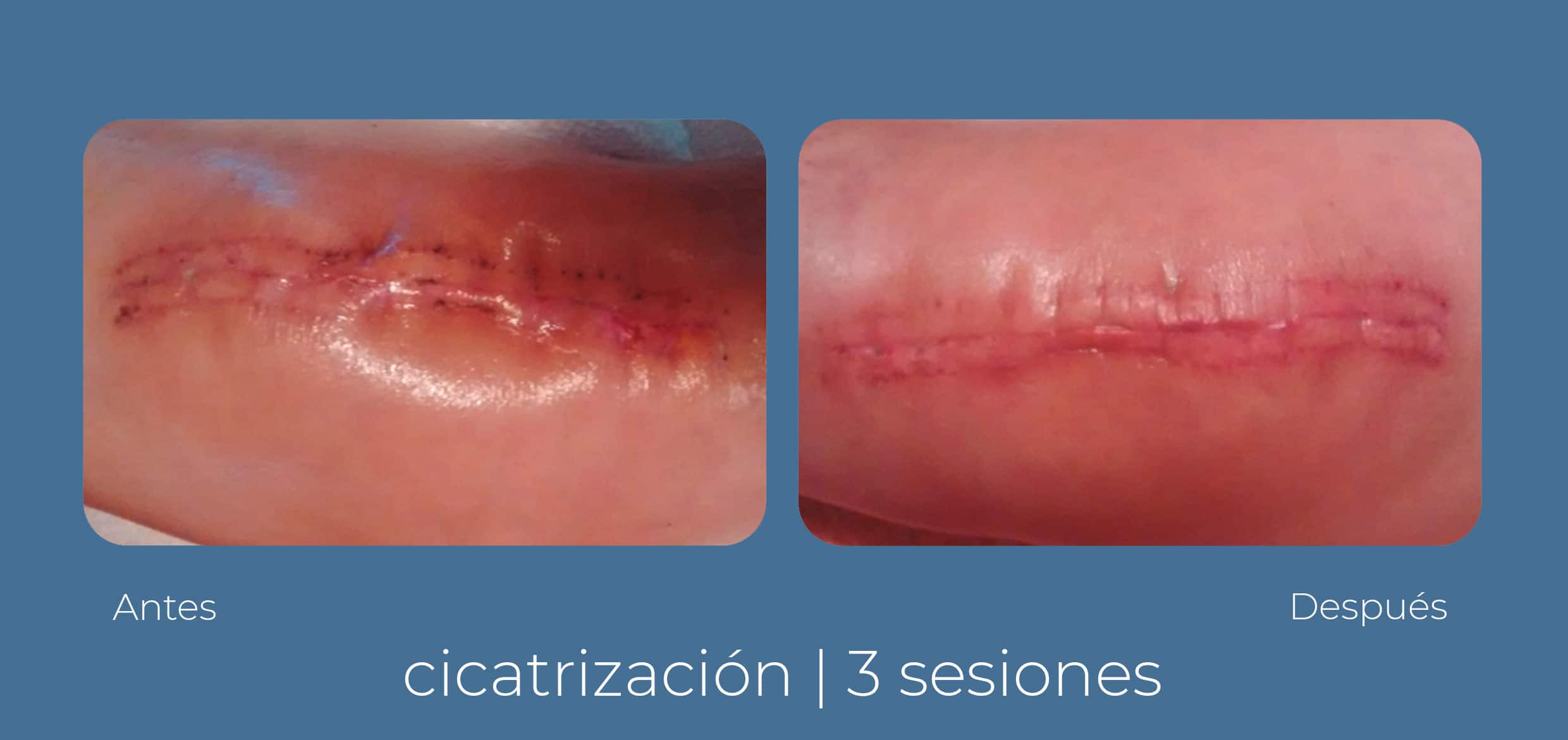 Antes y después de un tratamiento INDIBA para cicatrices postoperatorias