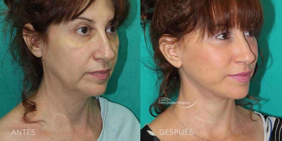 Antes y después de un lifting facial en España
