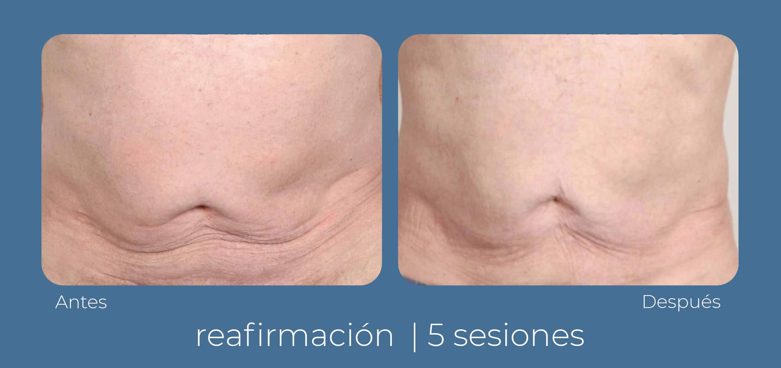 Vista frontal de cómo luce el abdomen luego de un tratamiento INDIBA para la flacidez corporal