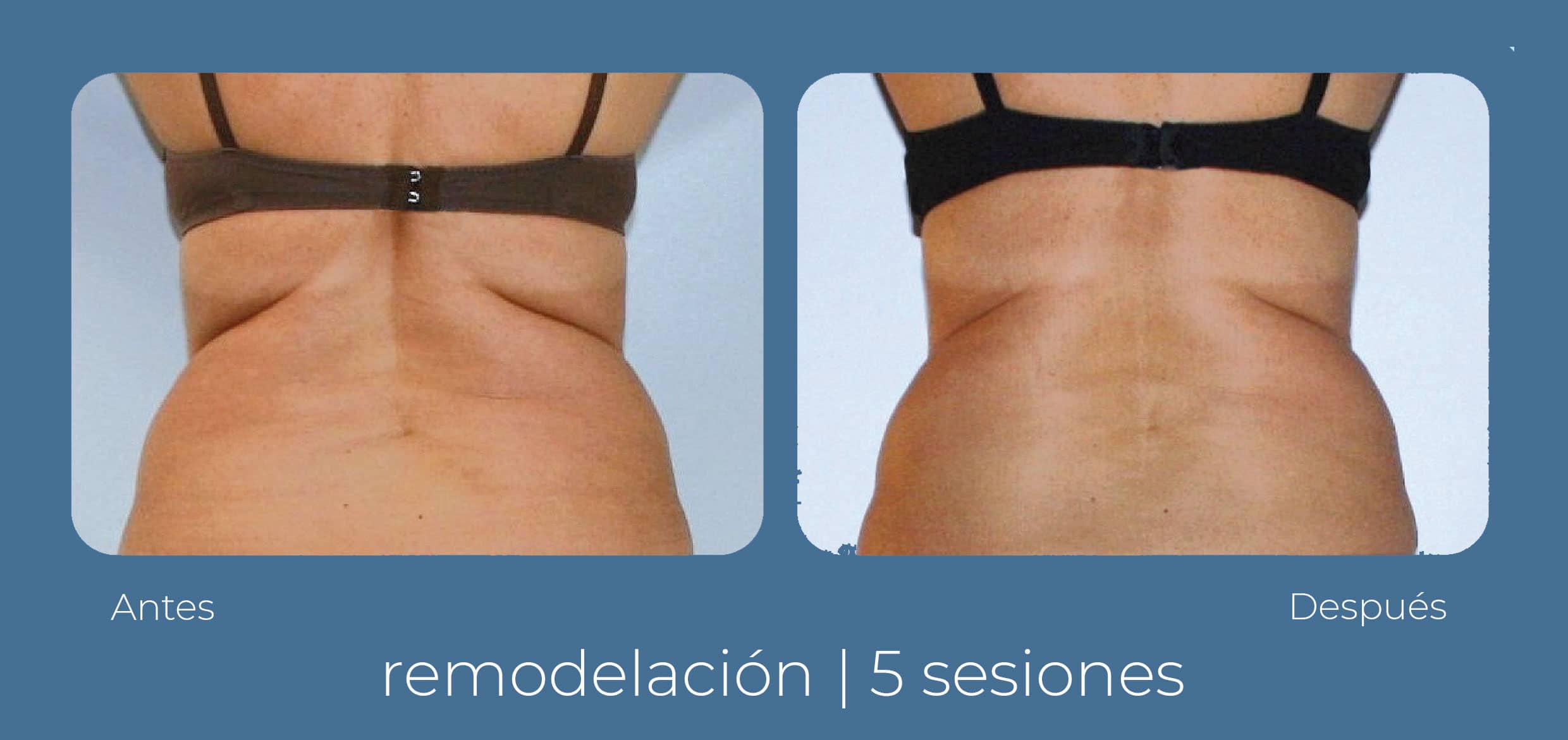 Vista dorsal del antes y después radiofrecuencia INDIBA corporal, realizada por el equipo de Clínica Fernández Blanco.