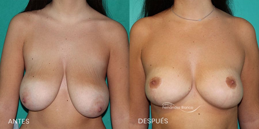 Reducción de mamas Caso 7