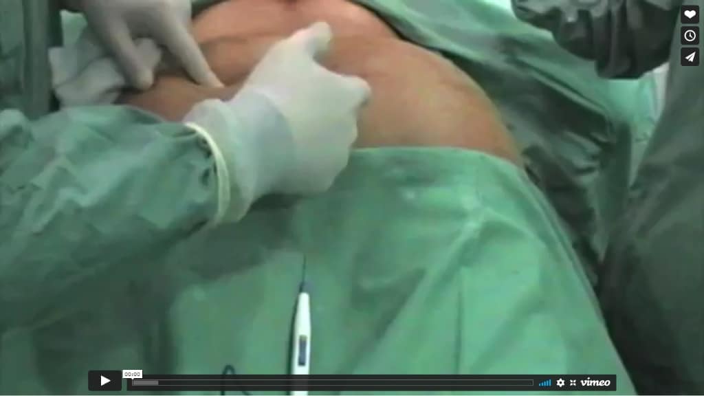 Video de una cirugía de gluteoplastia realizada en la Clínica Fernández Blanco