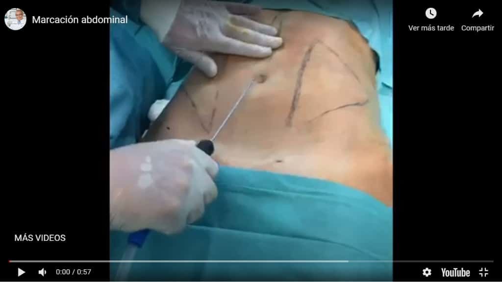 Video explicativo sobre cómo se hace una liposucción con marcación abdominal en la Clínica FB