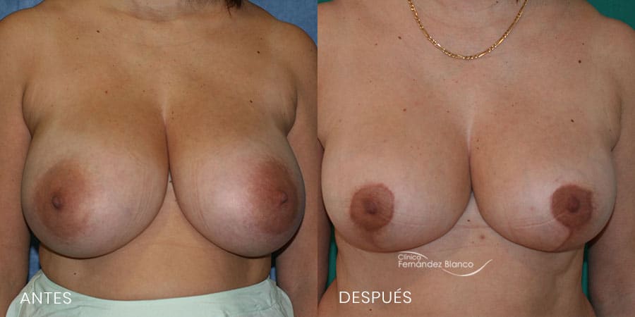 Reducción de mamas Caso 9