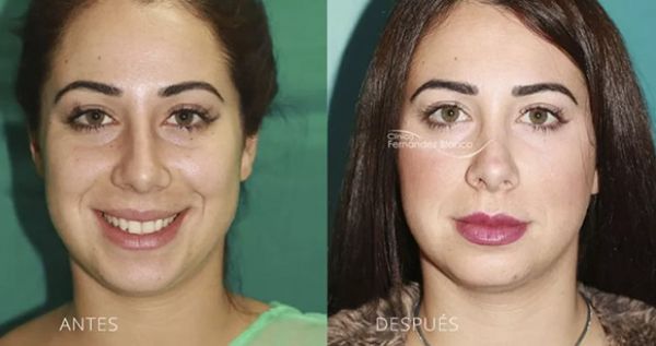 Vista frontal del antes y después cirugía de nariz realizada por el equipo de Clínica Fernández Blanco.