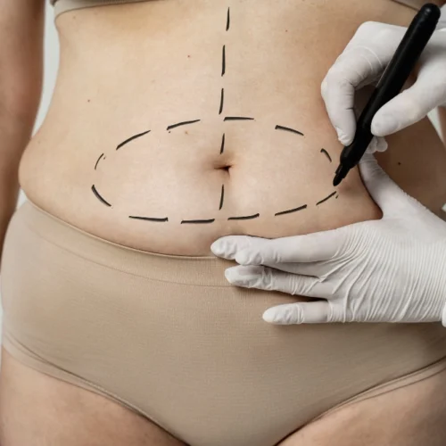 Difference between traditional and ultrasonic liposuction