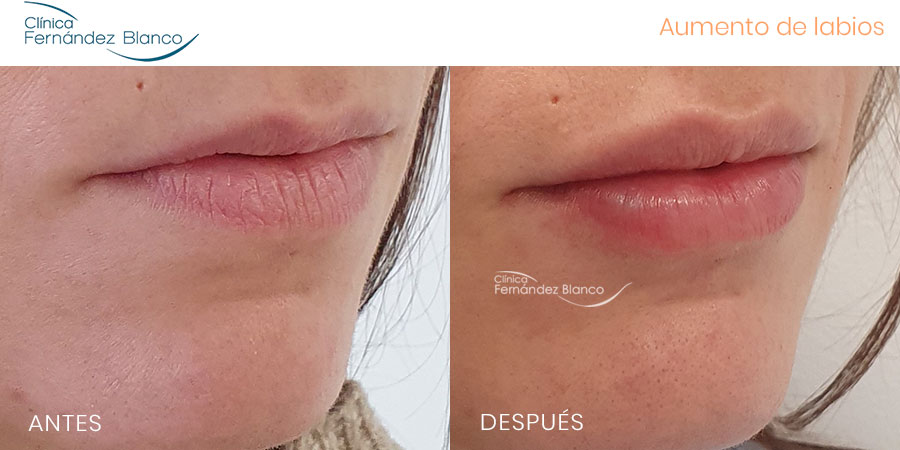 Antes y después relleno de labios con ácido hialurónico realizado en la Clínica Fernández Blanco