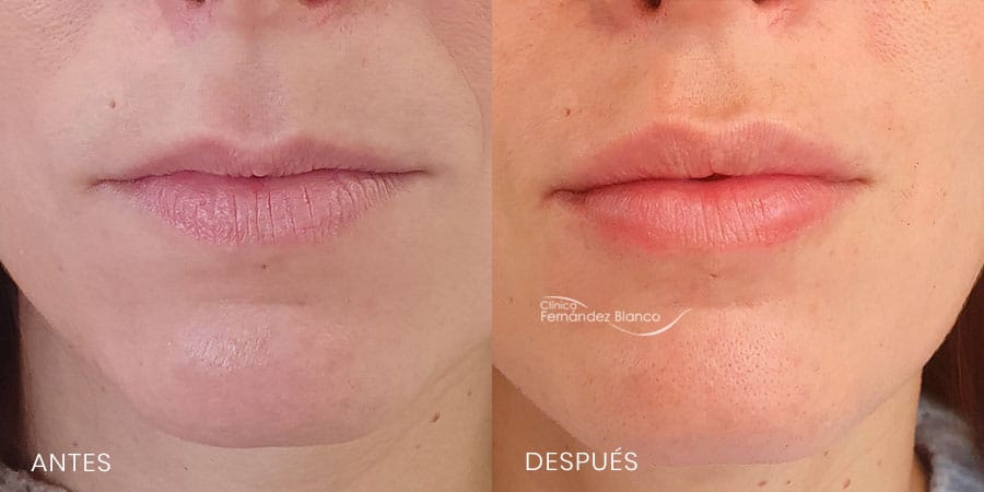 Antes y después de un aumento de labios ácido hialurónico