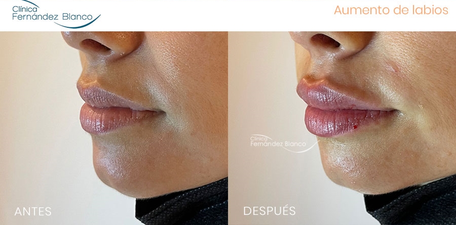 Fotos del antes y después ácido hialurónico labios realizado en la Clínica Fernández Blanco
