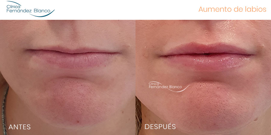 Vista frontal del antes y después de aumento de labios ácido hialurónico realizado en la Clínica Fernández Blanco
