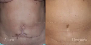 Vista frontal de una abdominoplastia secundaria realizada en Clínica Fernández Blanco