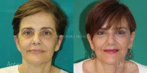 Lifting Facial secundario antes y después: Cirugía realizada por nuestros médicos cirujanos de Madrid