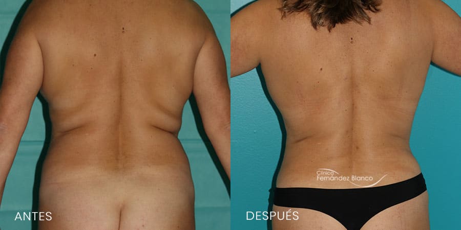 Antes y después de una liposucción de espalda y bra rolls