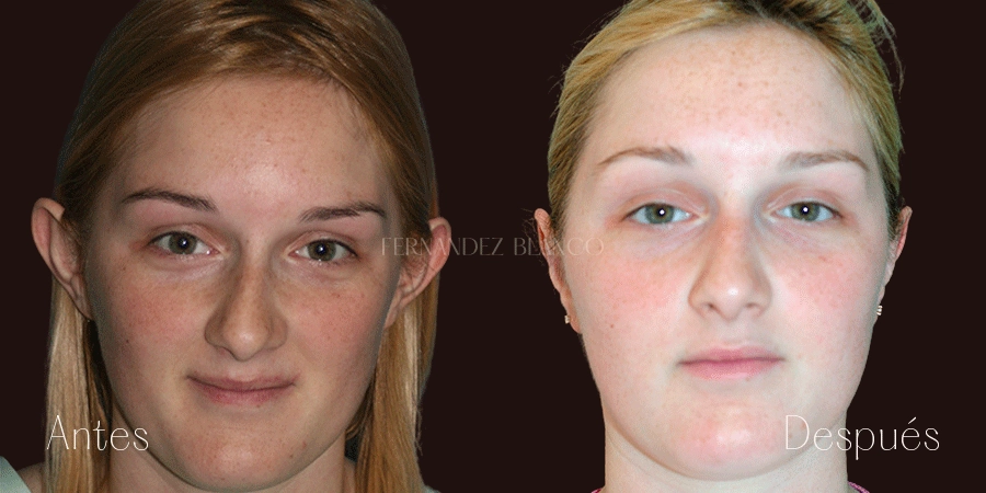 Otoplastia Madrid: ¿Qué es y cuáles son sus beneficios?