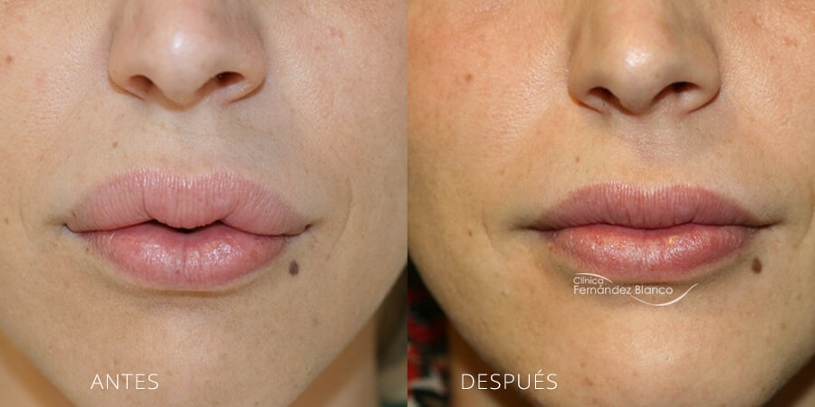 Antes y después de una cirugía de labios secundaria por un relleno de labios mal hecho