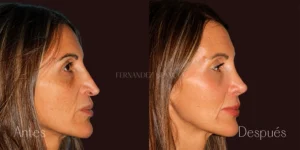 Antes y después de una rinoplastia secundaria realizada en nuestra clínica de cirugía estética en Madrid