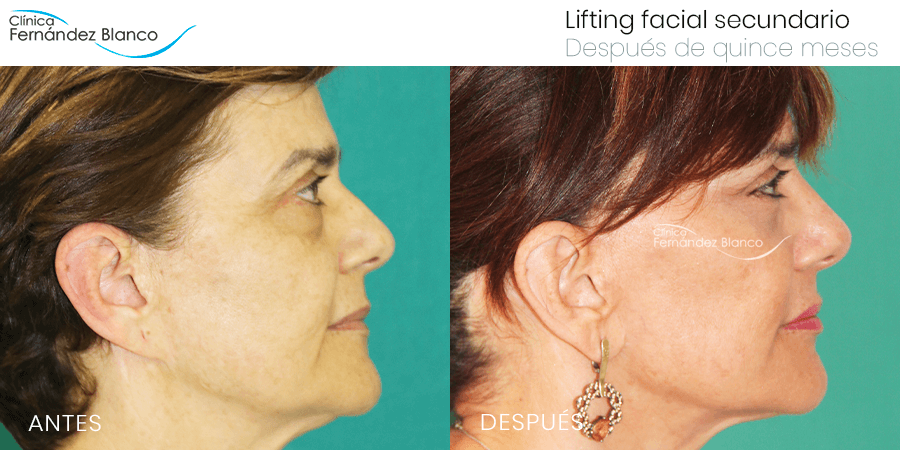 Antes y después de una cirugía secundaria de un lifting facial mal hecho