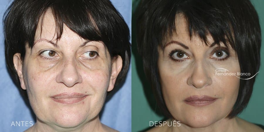 Por qué las personas se hacen una cirugía lifting facial