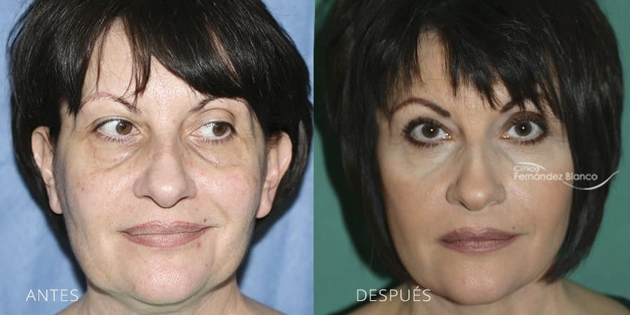 Why people undergo a facelift