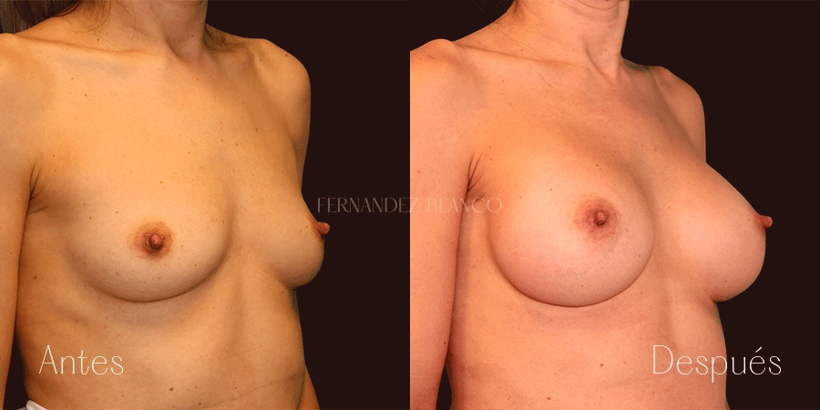 Vista lateral de un aumento de 300 cc pecho realizado en la Clínica Fernández Blanco