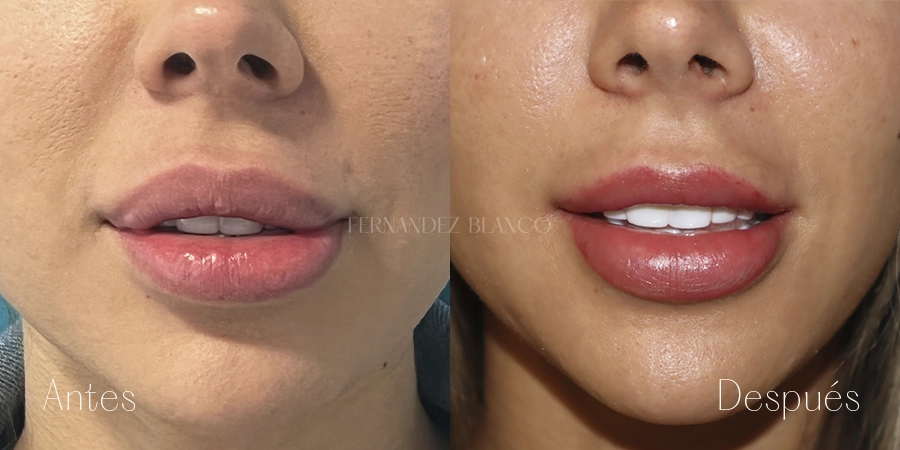 Antes y después de una extracción de biopolímeros en labios | Cirugía realizada en la Clínica Fernández Blanco