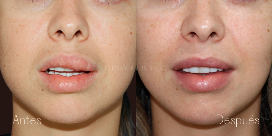 Biopolymers in lips