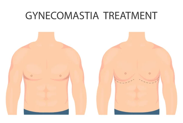 Antes y después de una ginecomastia en hombres
