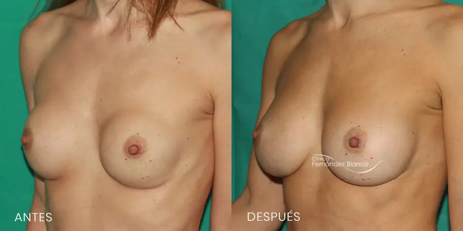 Fotografía del antes y después de los síntomas de contractura capsular