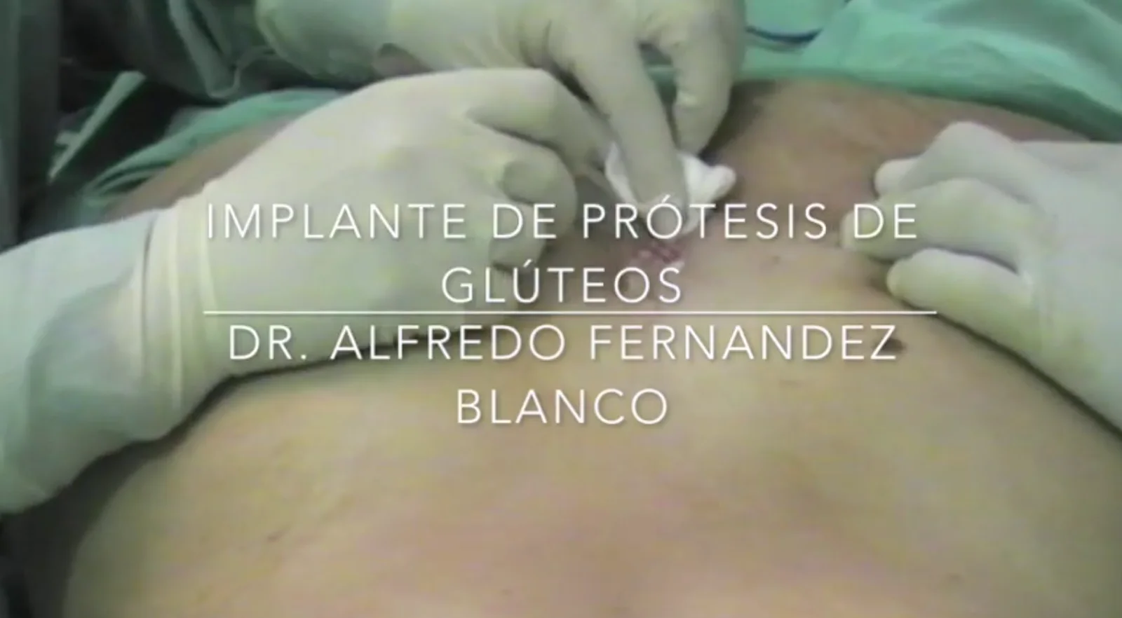Video explicativo sobre cómo se colocan los implantes de prótesis de glúteos