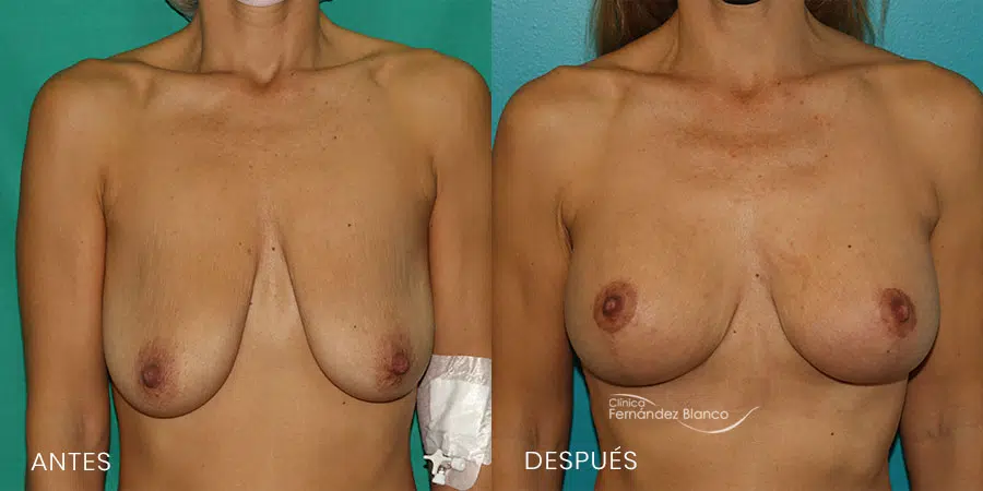 Mastopexy bad results before and after