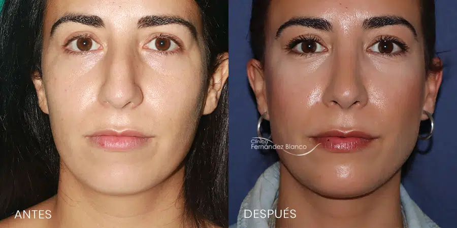 Tratamientos faciales - Rinoplastia - Antes y Después