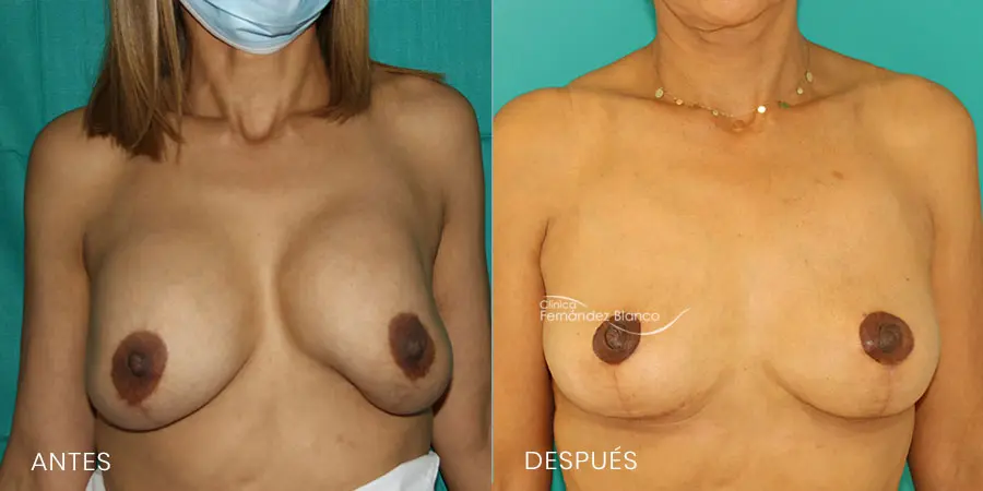 Antes y después de un explantación de prótesis