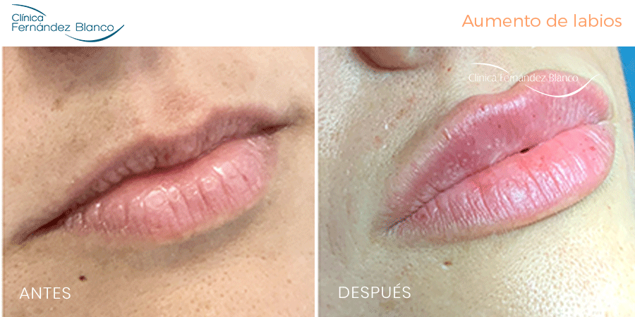 Antes y después aumento de labios con ácido hialurónico | Clínica Fernández Blanco