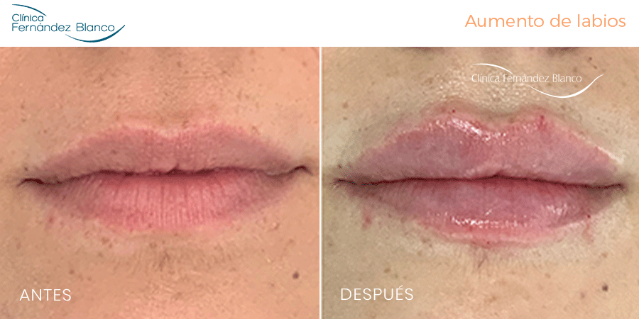 Vista frontal de aumento de labios ácido hialurónico antes y después, realizado en la Clínica Fernández Blanco