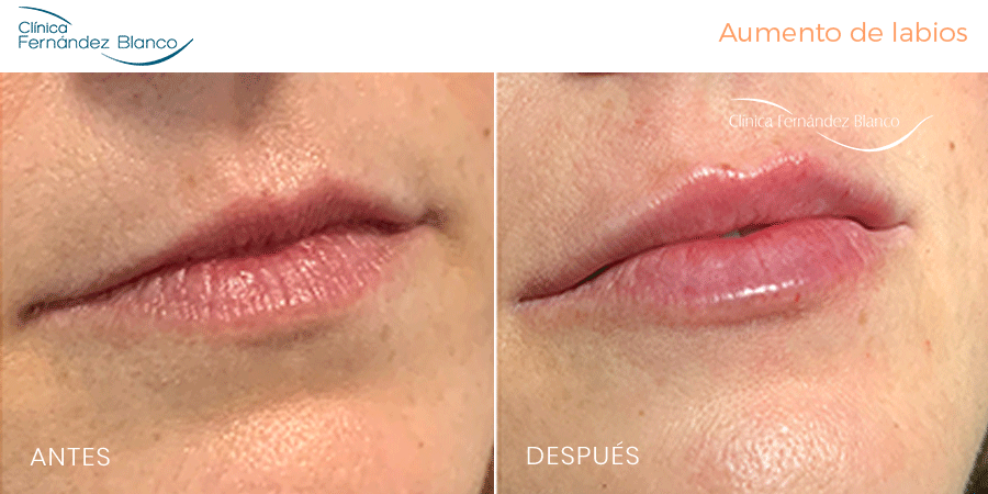 Vista frontal de un increíble aumento de labios mujer realizado en la Clínica FB