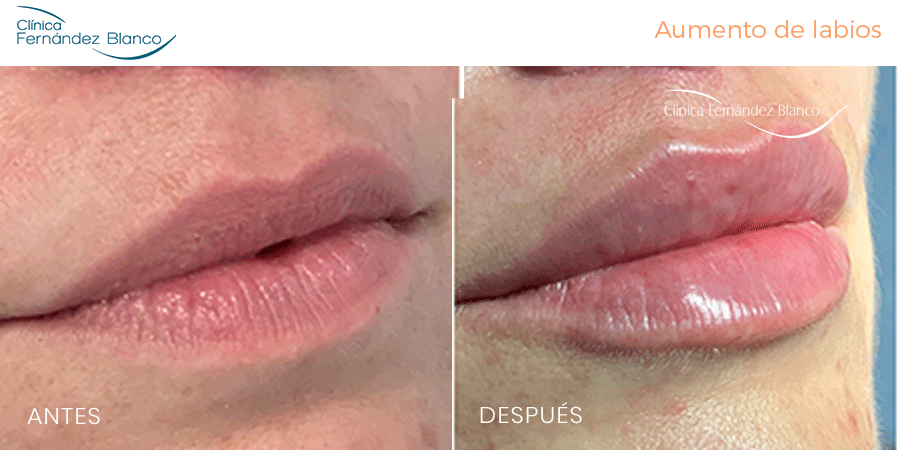Vista de perfil antes y después labios rellenos con ácido hialurónico, realizado en la Clínica FB
