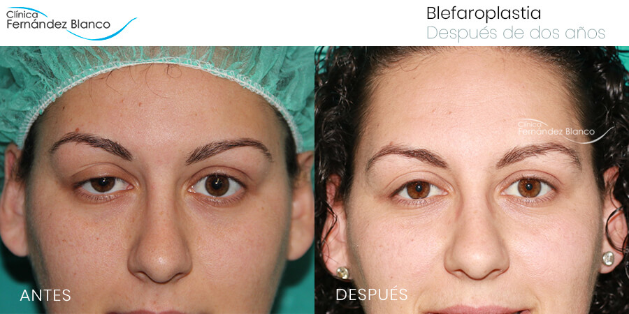 Antes y después de una cirugía de párpados superior realizada en Clínica FB 