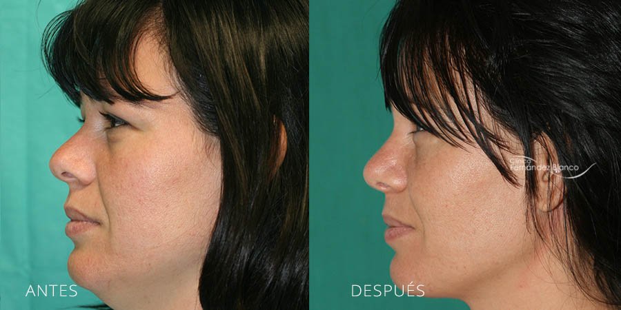 Antes y después de una bichetomía con redefinición de pómulos y mandíbula, realizada en Clínica Fernández Blanco