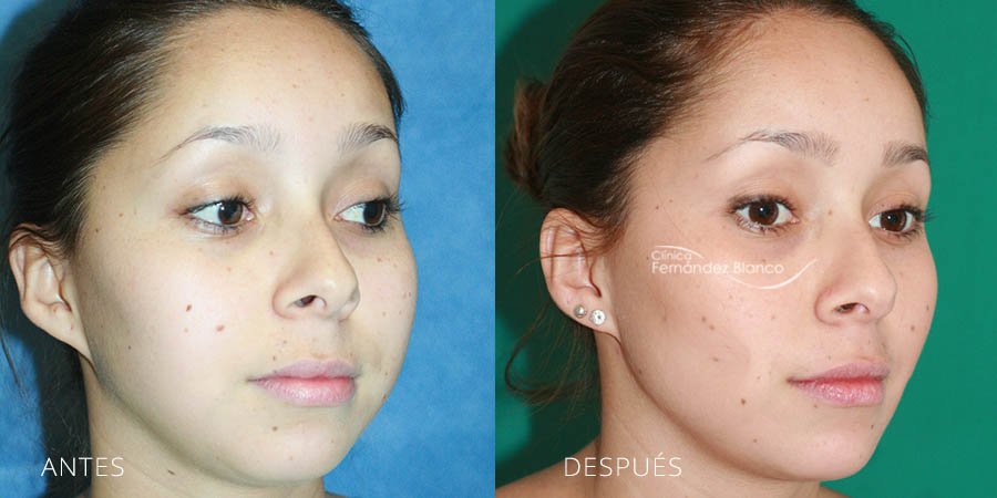 Antes y después de extracción de bolas de bichat en paciente joven, realizada en Clínicas Fernández Blanco
