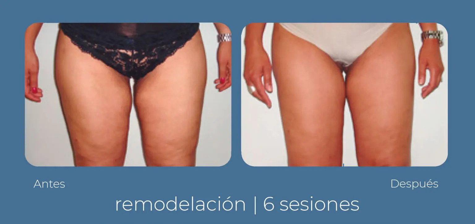 Find out how to get rid of cellulite on legs with INDIBA