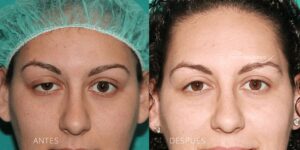 Ventajas y desventajas de realizarse una blefaroplastia