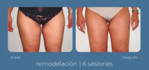 What the before and after of an INDIBA treatment looks like