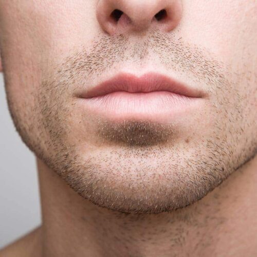 Mentoplasty and gonion implants: male facial surgeries