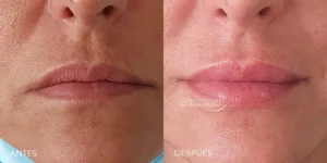Cosas que deberías saber antes de hacerte una operación de aumento de labios antes y después de realizarla