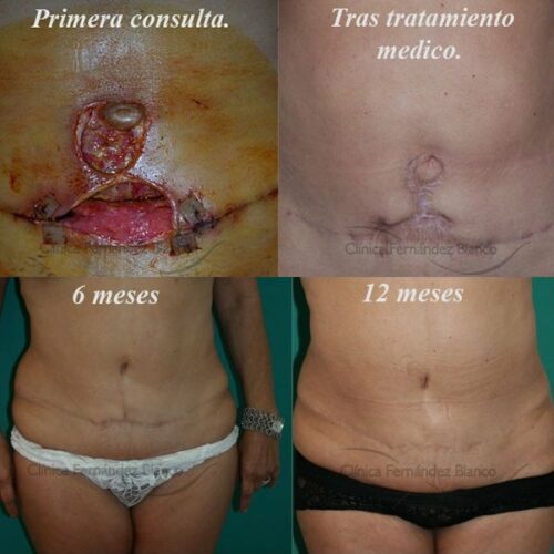 Secondary tummy tuck in Madrid