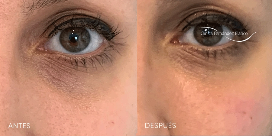 How to remove dark circles