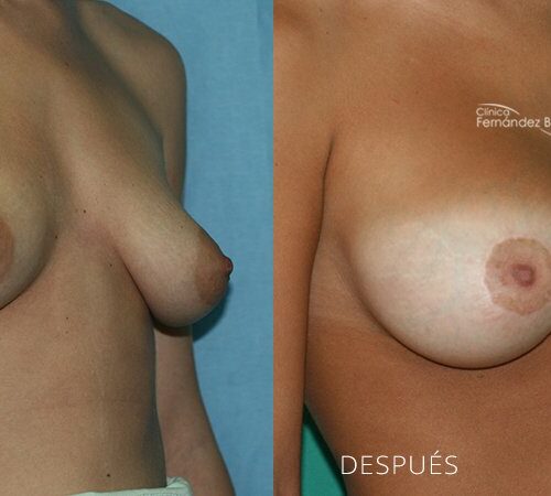 Periareolar breast lift