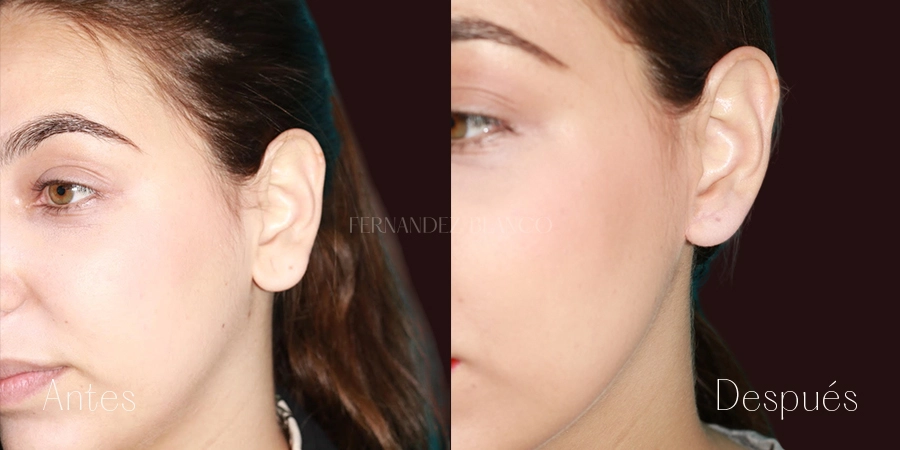 Antes y después de Claudia. Lobuloplastia con reducción de lóbulos realizada en la Clínica Fernández Blanco